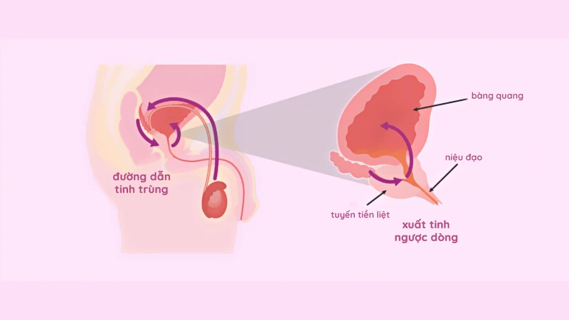 Có nhiều phương pháp điều trị xuất tinh ngược dòng