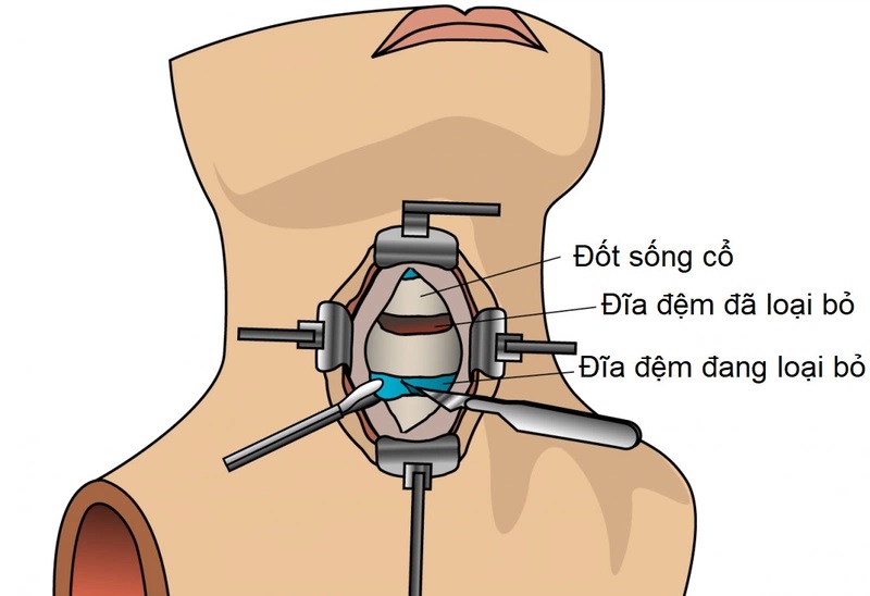 Mô phỏng phẫu thuật ACDF