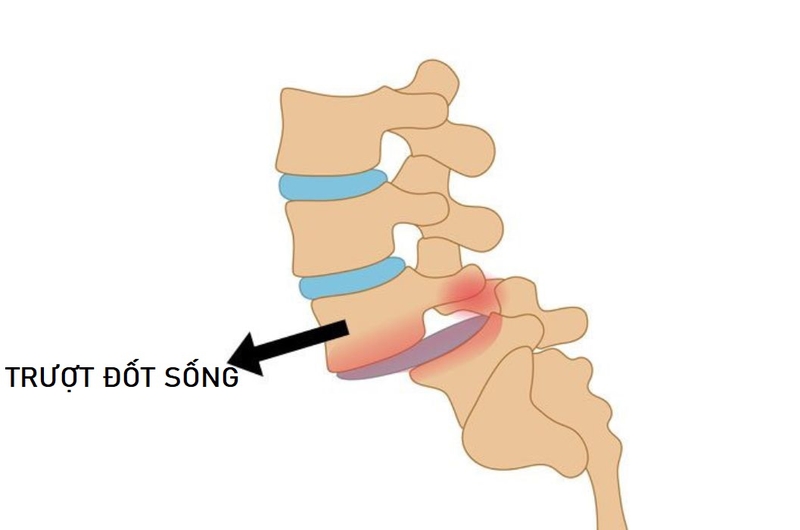 Trượt đốt sống được phân chia thành nhiều cấp độ khác nhau