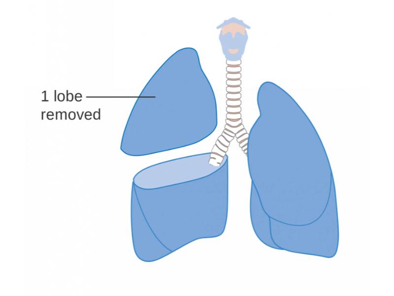 Phẫu thuật cắt bỏ một thùy phổi