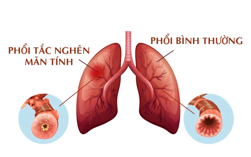 Phương Pháp Điều Trị COPD