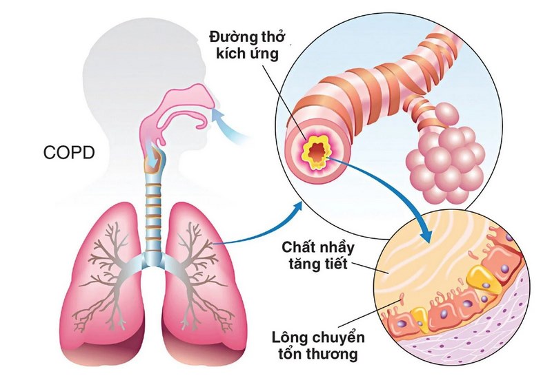 Triệu Chứng Của COPD