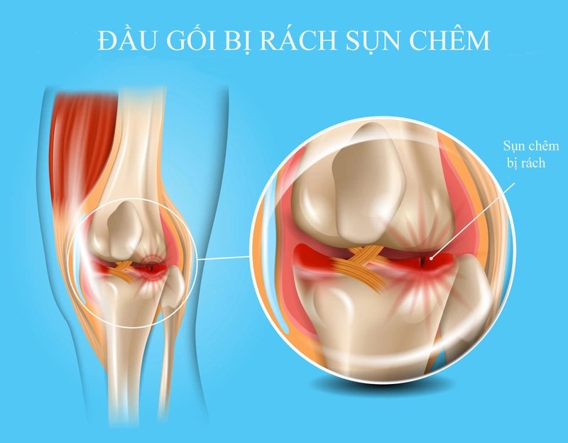 Sụn chêm bị rách sẽ làm cho người bệnh đau đớn và khó vận động