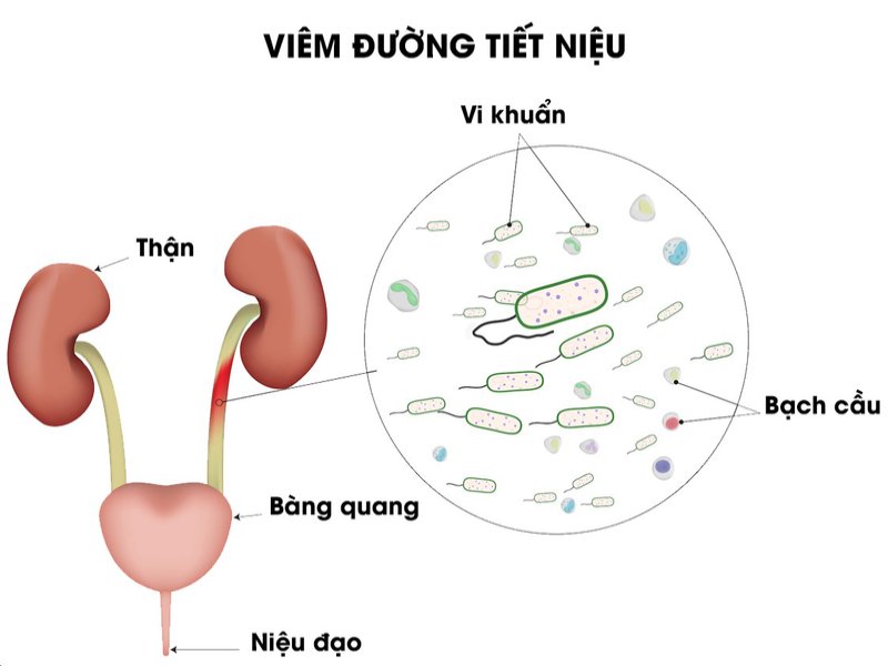 Nhiễm trùng tiểu là nguy cơ gây đau bụng sau khi quan hệ