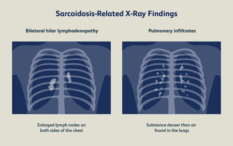 Chẩn đoán Sarcoidosis thường dựa vào việc loại trừ các bệnh khác