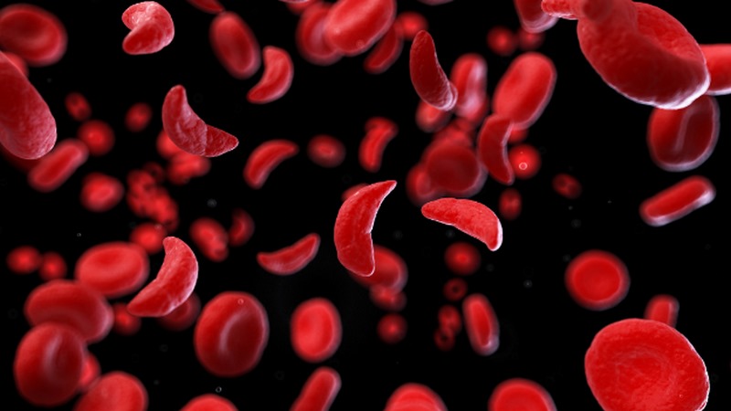 Sickle cell disease là một nhóm các rối loạn di truyền