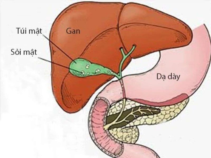 Bệnh sỏi mật cần phải chữa trị kịp thời để không gây ra những biến chứng nguy hiểm