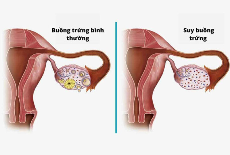 Bệnh suy buồng trứng sớm là gì?