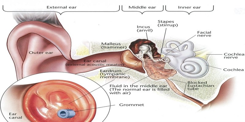 Đặt ống thông màng nhĩ, một thủ tục nhỏ giúp giảm áp lực và chảy dịch từ tai giữa