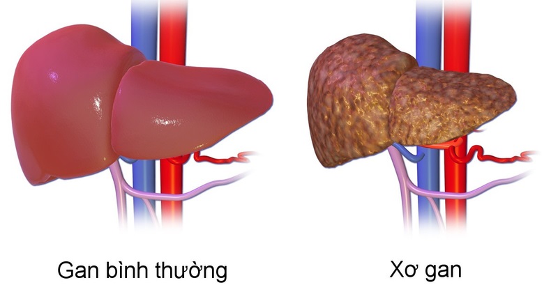 Các yếu tố góp phần gây hạ natri máu trong xơ gan