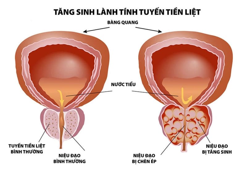 Tăng sản tuyến tiền liệt là gì