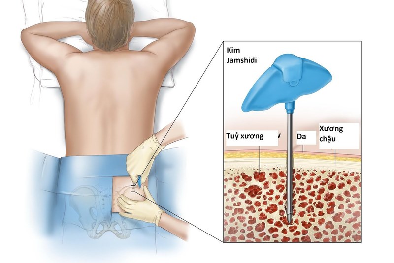 Sinh thiết tủy xương được dùng để chẩn đoán bệnh tăng tiểu cầu tiên phát