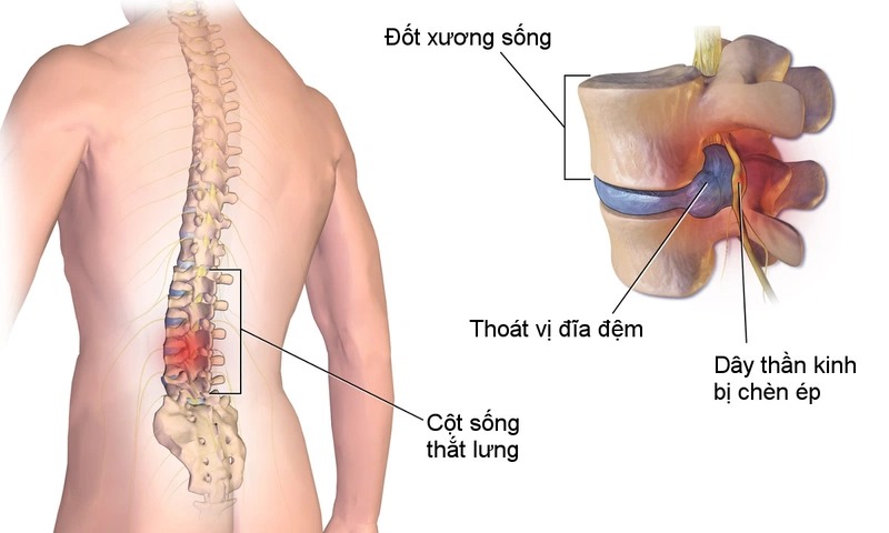 Thoát vị đĩa đệm gây đau đớn, ảnh hưởng đến chất lượng cuộc sống 