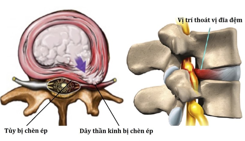 Thoát vị đĩa đệm ở đốt sống cổ C3 C4