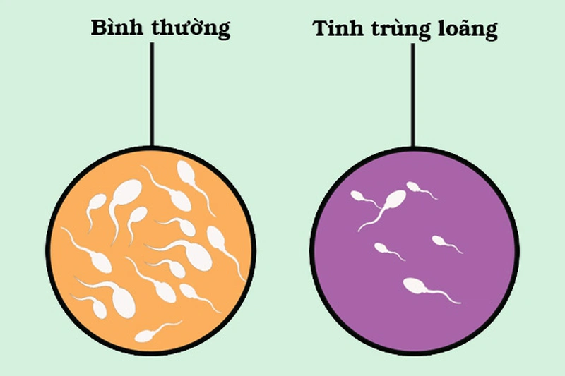 Một số dấu hiệu nhận biết tinh trùng loãng