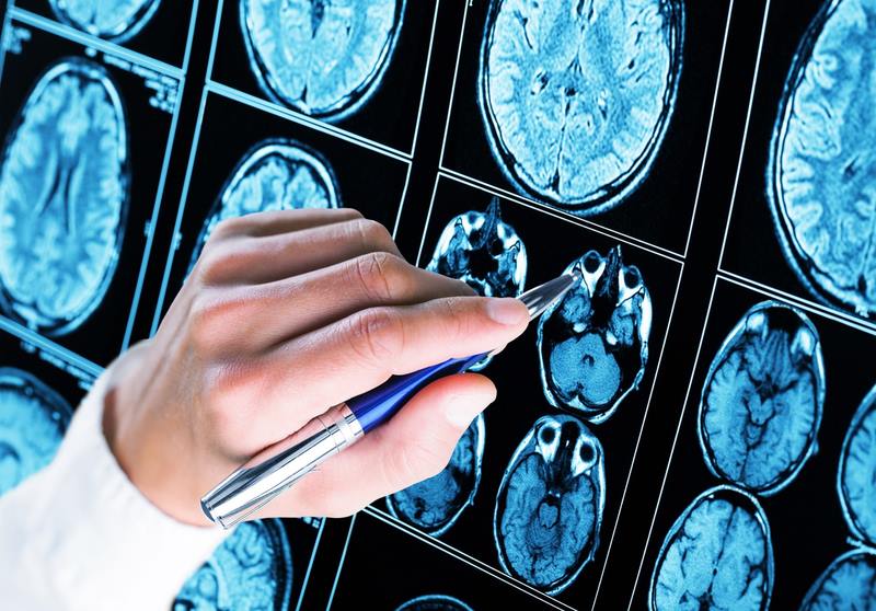 Thuốc chống trầm cảm được sử dụng để điều trị đau đầu mãn tính