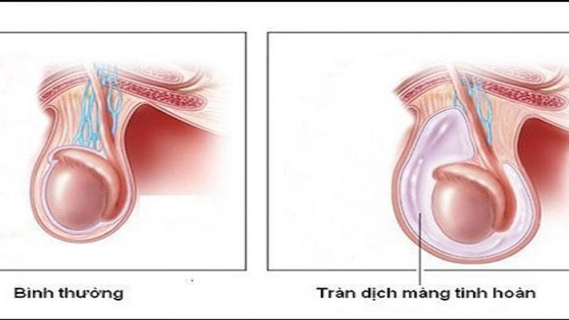 Tràn dịch màng tinh hoàn, còn gọi là hydrocele