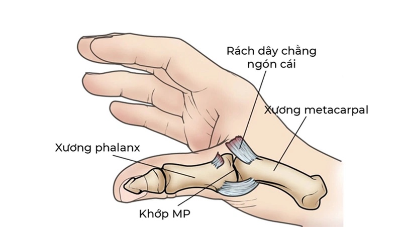 Trật khớp ngón tay là một chấn thương khá phổ biến