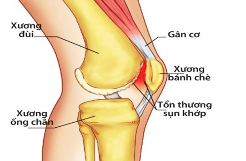 Trật xương bánh chè là một chấn thương nghiêm trọng