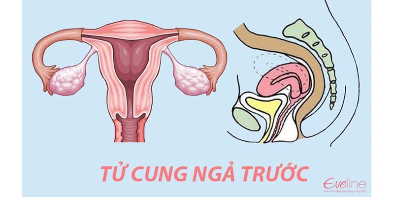 Tử cung ngả trước là một hiện tượng phổ biến