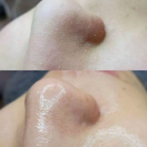 Ủ mụn đầu đen ONmacabim Removes BlackHeads