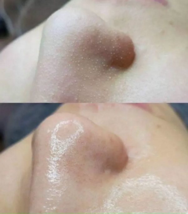 Ủ mụn đầu đen ONmacabim Removes BlackHeads