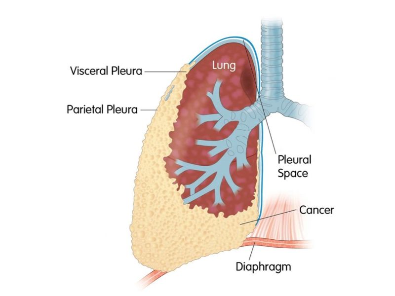 Ung thư màng phổi là căn bệnh nguy hiểm