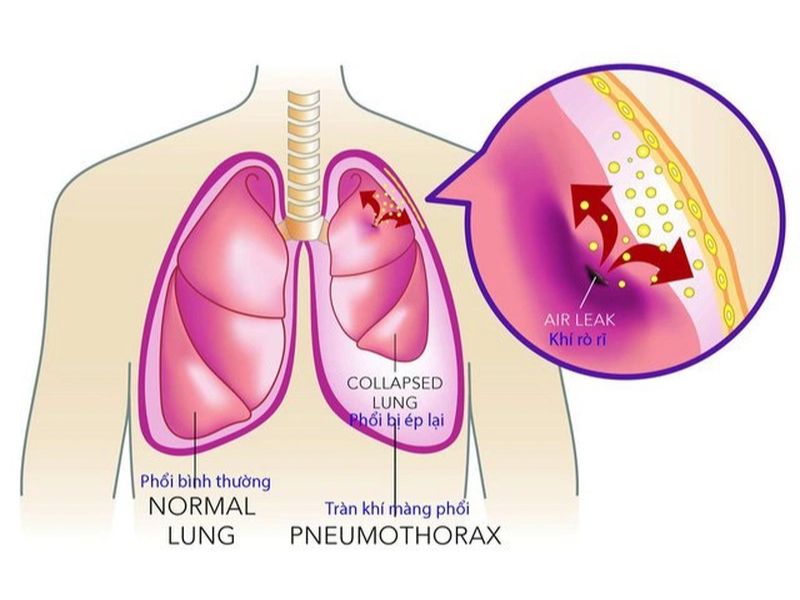 Ung thư màng phổi gây ảnh hưởng đến sức khỏe