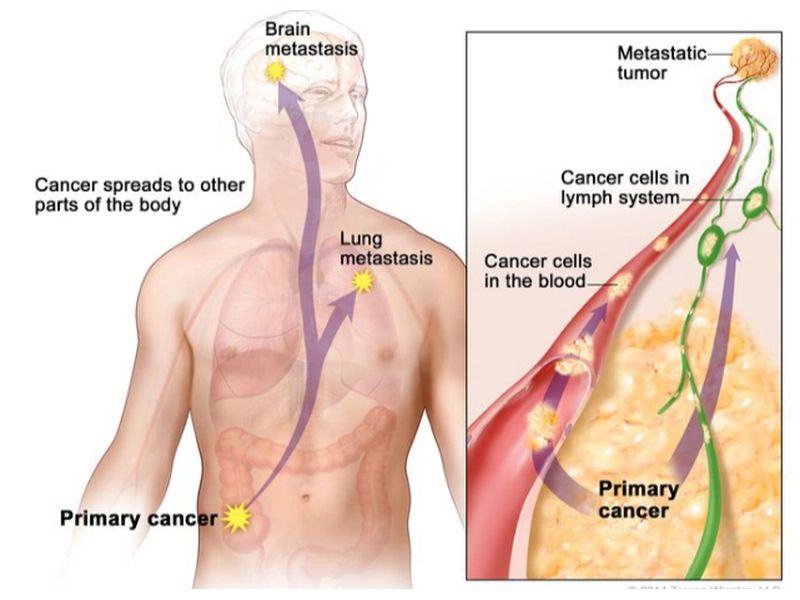 Các giai đoạn phát triển của ung thư phổi di căn màng phổi