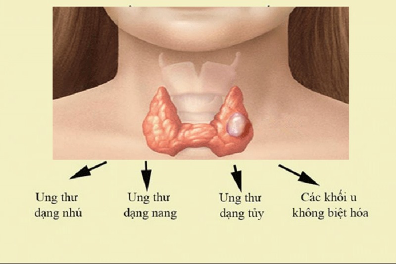 Các loại ung thư tuyến giáp