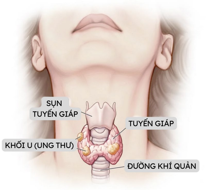 Căn bệnh ung thư tuyến giáp có nguy hiểm không?