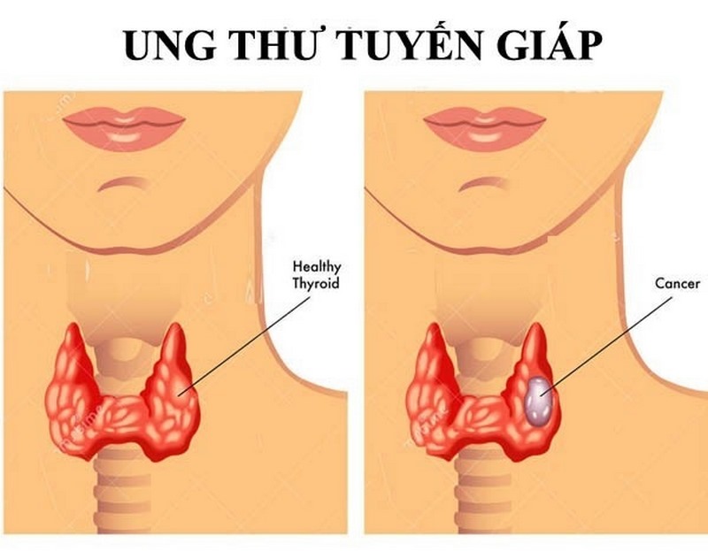 Điều trị ung thư tuyến giáp