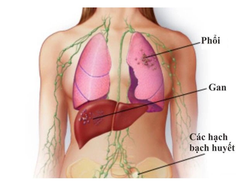 Ung thư phổi di căn gan