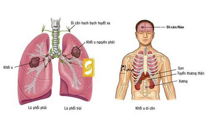 Ung thư phổi di căn não và xương sống được bao lâu?