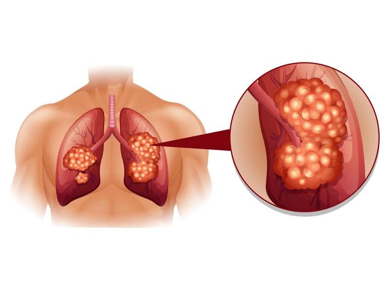 Nên khám sức khỏe định kỳ để tầm soát ung thư phổi