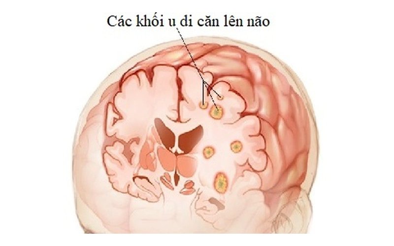 Ung thư phổi di căn não là gì?