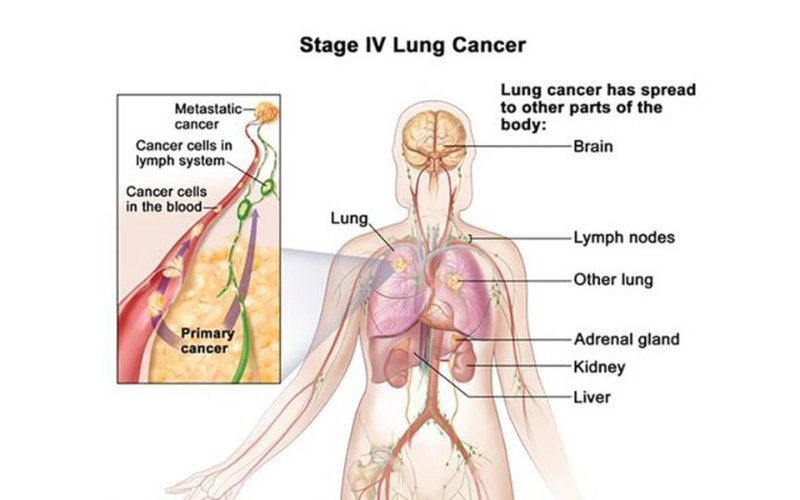 Các dấu hiệu của ung thư phổi di căn não