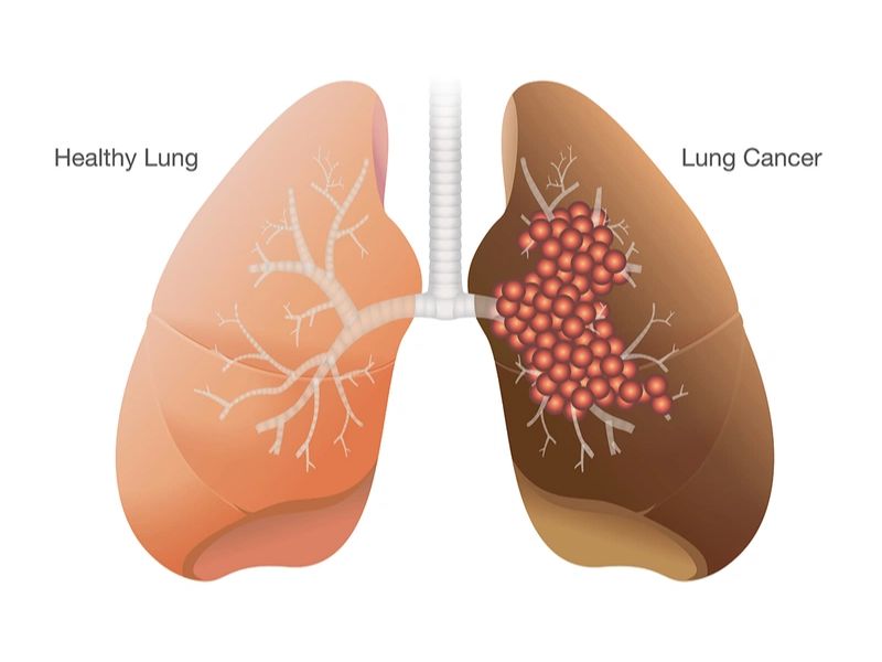 Ung thư phổi giai đoạn cuối thật sự rất nguy hiểm