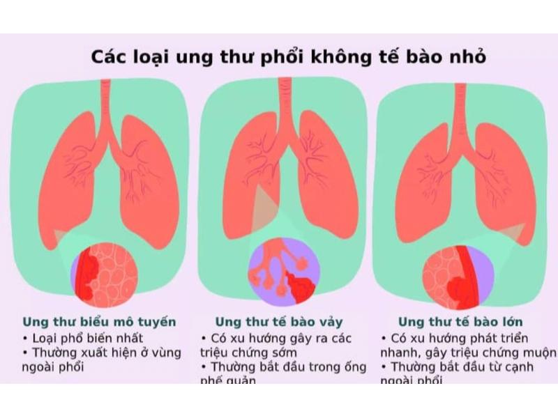 Ung thư phổi không tế bào nhỏ (NSCLC) là một trong hai loại ung thư phổi chính, chiếm khoảng 85% tất cả các trường hợp ung thư phổi.