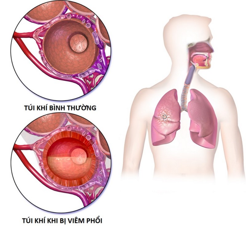 Nhiễm trùng vi khuẩn Klebsiella pneumoniae gây ra những triệu chứng nào?