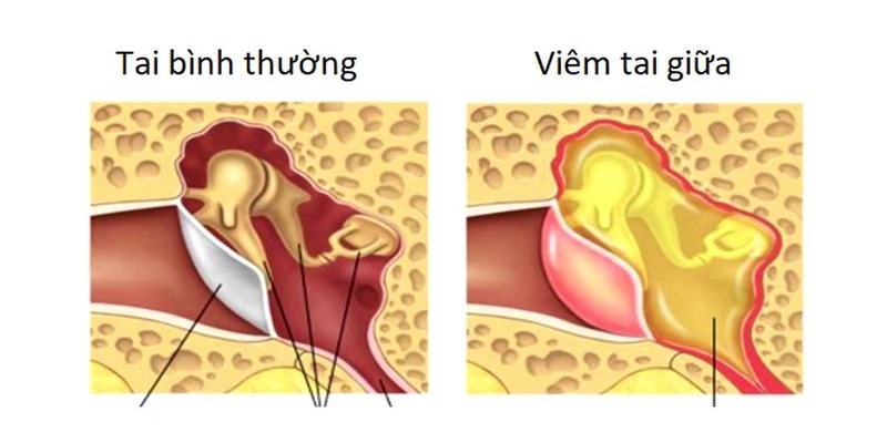 Bệnh viêm tai giữa có thể gây ù tai