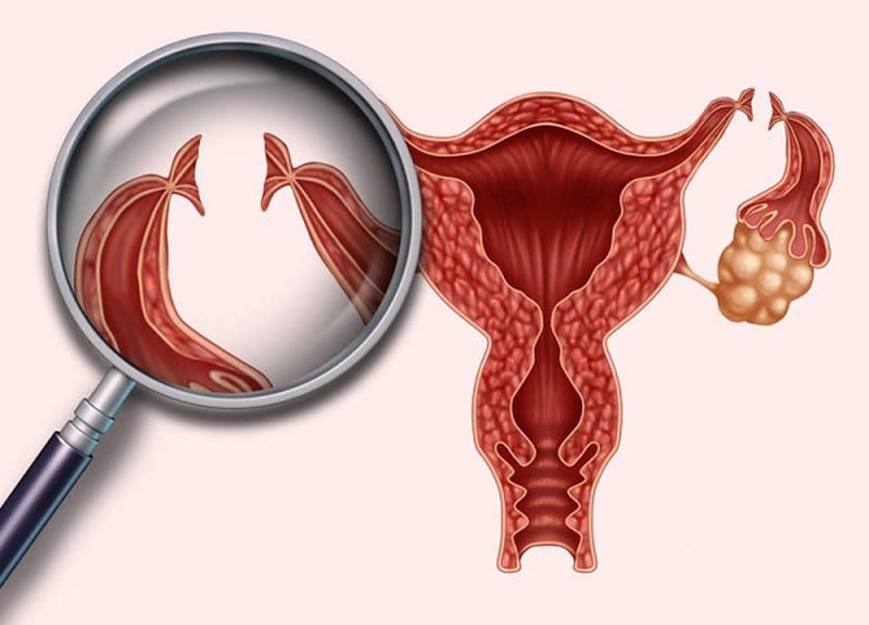 Viêm ống dẫn trứng do vi khuẩn xâm nhập ngược dòng vào trong