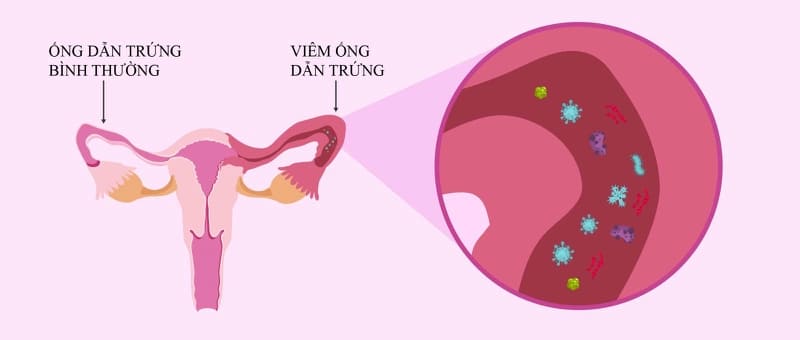 Quan hệ tình dục không an toàn là nguyên nhân dẫn đến viêm ống dẫn trứng