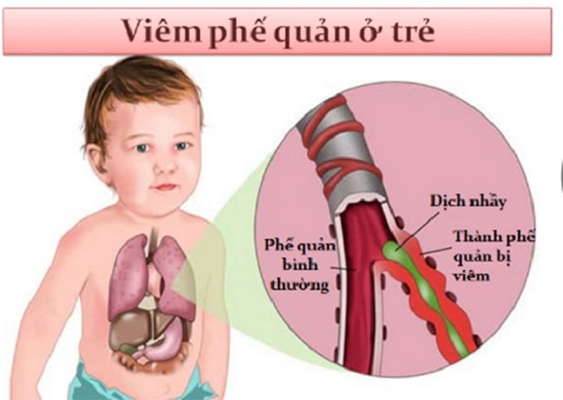 Nguyên nhân của viêm phế quản cấp tính ở trẻ em