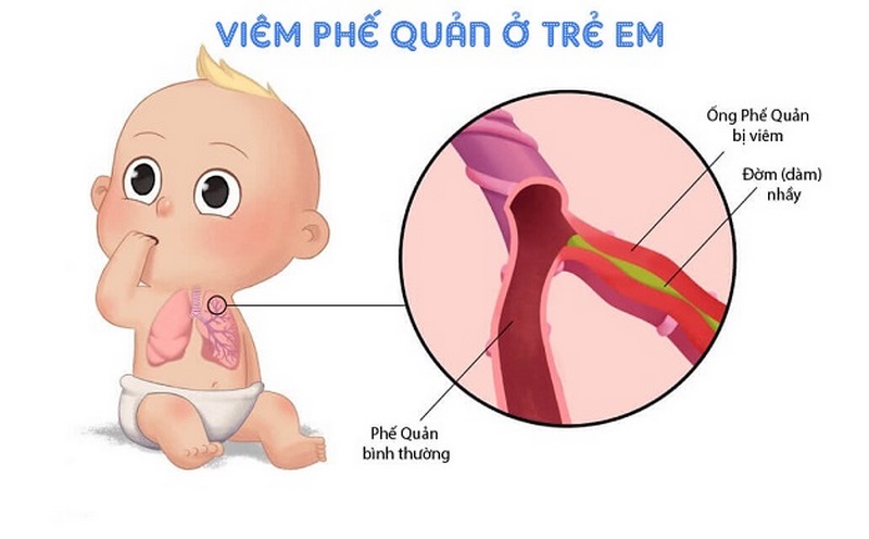 Cách điều trị viêm phế quản cấp tính ở trẻ em