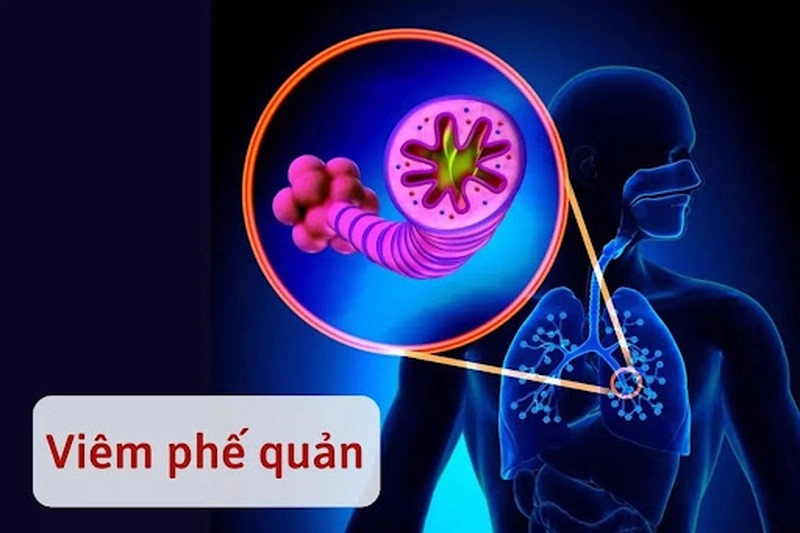 Triệu chứng của viêm phế quản co thắt