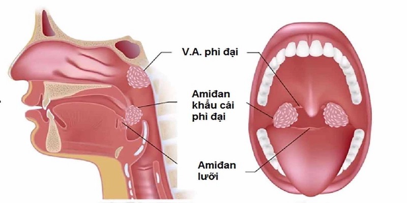 Nếu màng nhĩ bị thủng, dịch có thể chảy ra ngoài