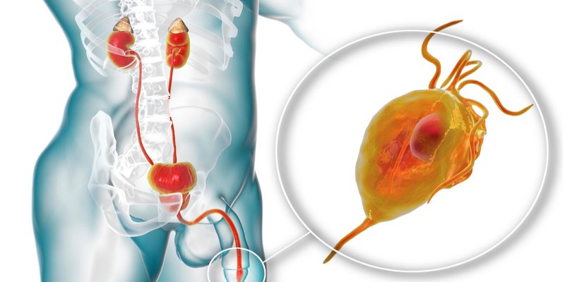 Viêm tuyến tiền liệt là một trong những nguyên nhân gây đau bụng dưới bên trái ở nam