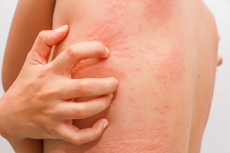 Nổi mề đay, còn được gọi là urticaria