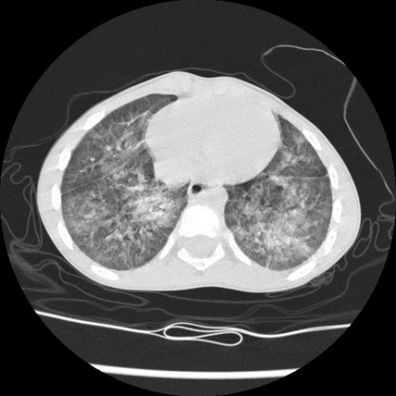 CT scan ngực giúp chẩn đoán xuất huyết phế nang hiệu quả